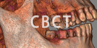 CBCT